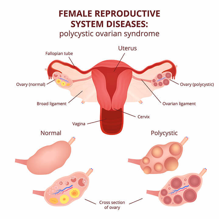 PCOS symptomen, menstruatie en zwanger worden | mijn ervaring