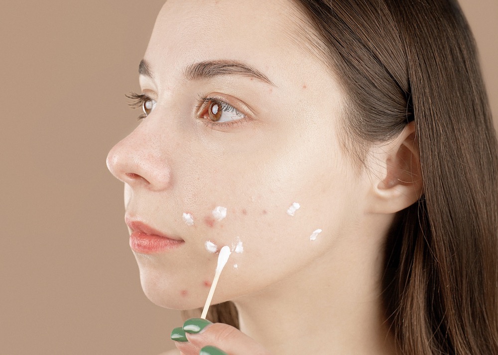 5 tips om zelf je acne littekens pigmentvlekken te |