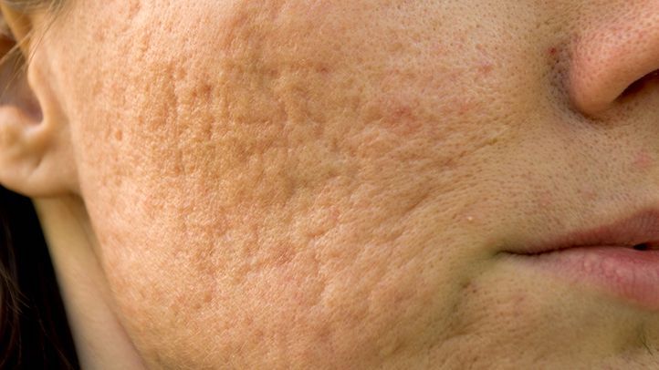 5 tips om zelf je acne littekens te vervagen