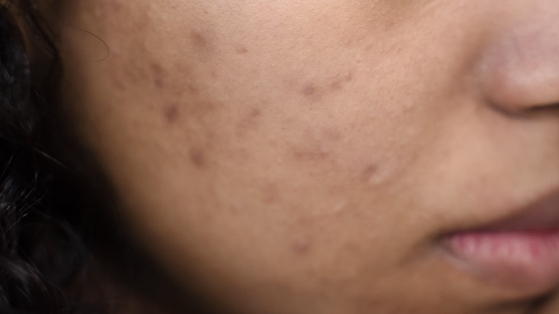 5 tips om zelf je acne littekens en pigmentvlekken te vervagen
